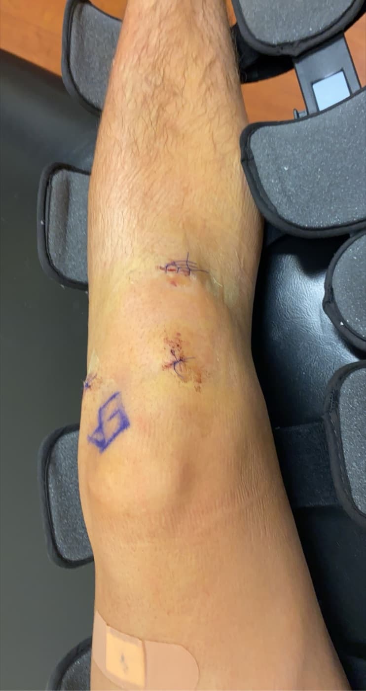 Chris's leg six days after knee surgery, stitches and marker still visible, resting in a brace